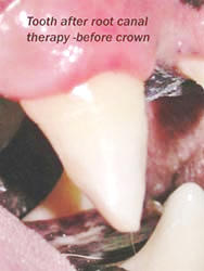 Tooth after root canal therapy- before the crown.