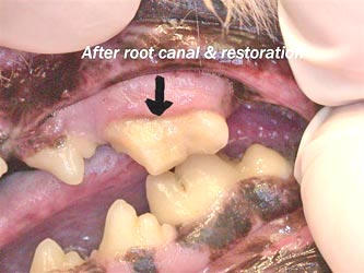 After root canal and restoration