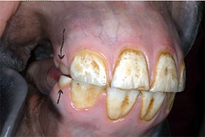 Deciduous teeth