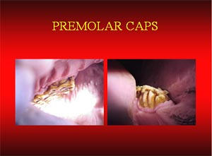 Premolar caps