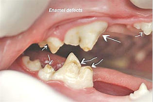 Enamal defects