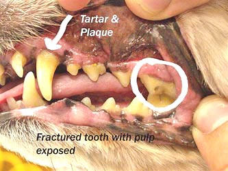 Fractured tooth