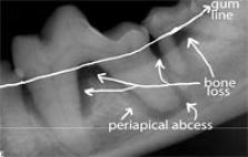 X-ray showing bone loss